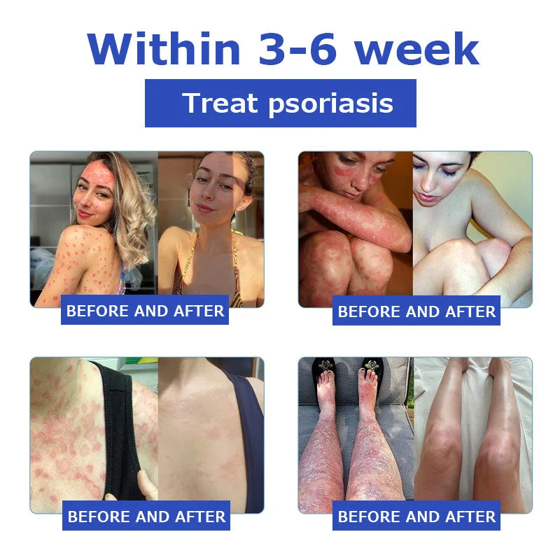 OceanCure Bee Venom Psoriasis & Wart Healing Cream - Image 6