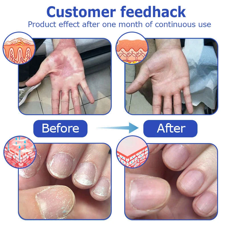 OceanCure Bee Venom Psoriasis & Wart Healing Cream - Image 9