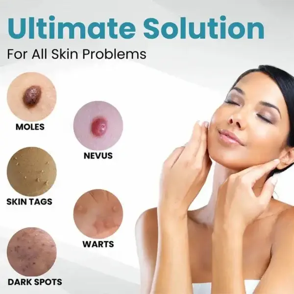 Non-Invasive Mole and Wart Removal Laser Pen - Image 3
