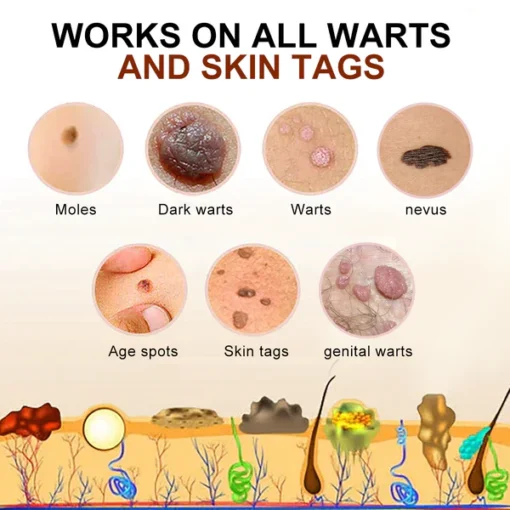 Bee Venom Mole and Wart Treatment Cream - Image 5