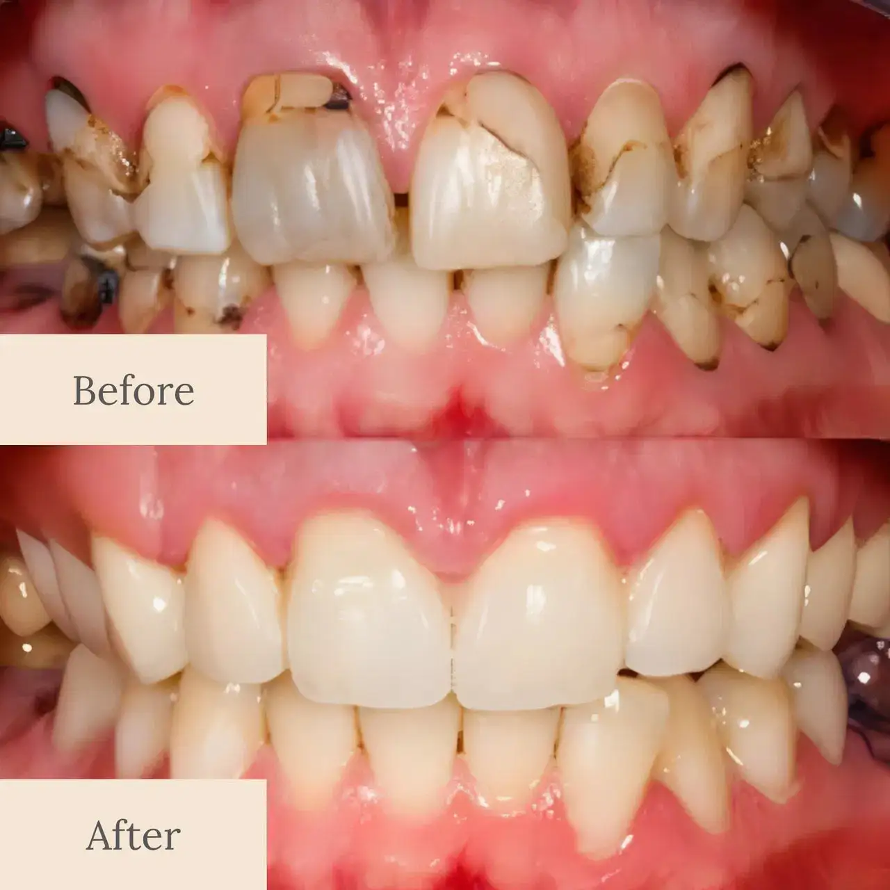 Teeth Armor Drops - Image 3