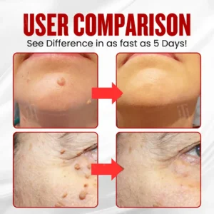 Alternative view of WartAway Pro Patches