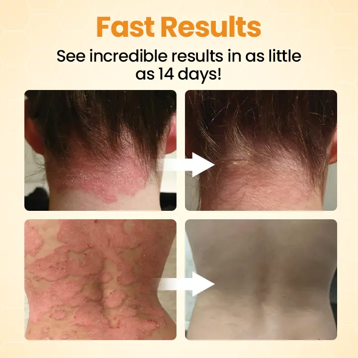 BeeLieve Psoriasis Skin Care - Image 3