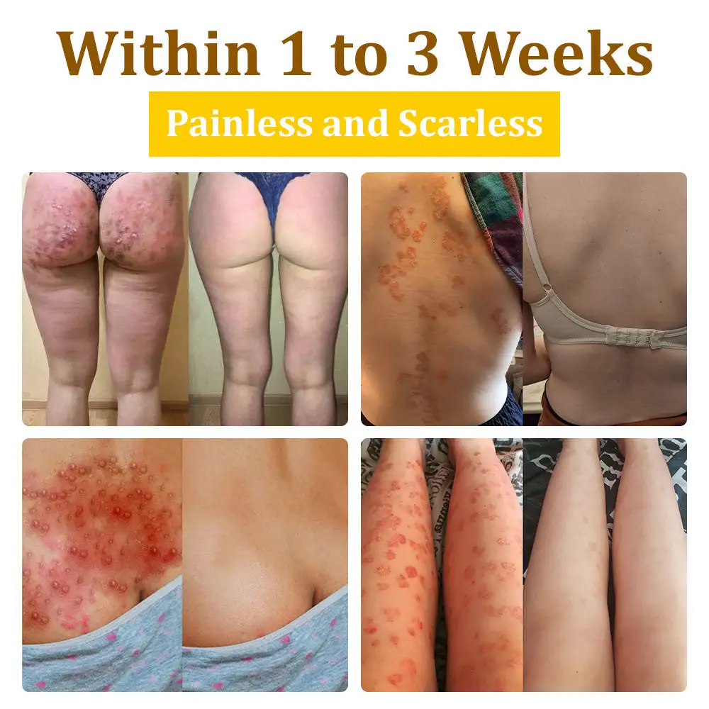 Bee Venom Treatment Cream🐝: Treat Eczema, Psoriasis, Acne, Rosacea, Fungal Infections, Warts - Image 2