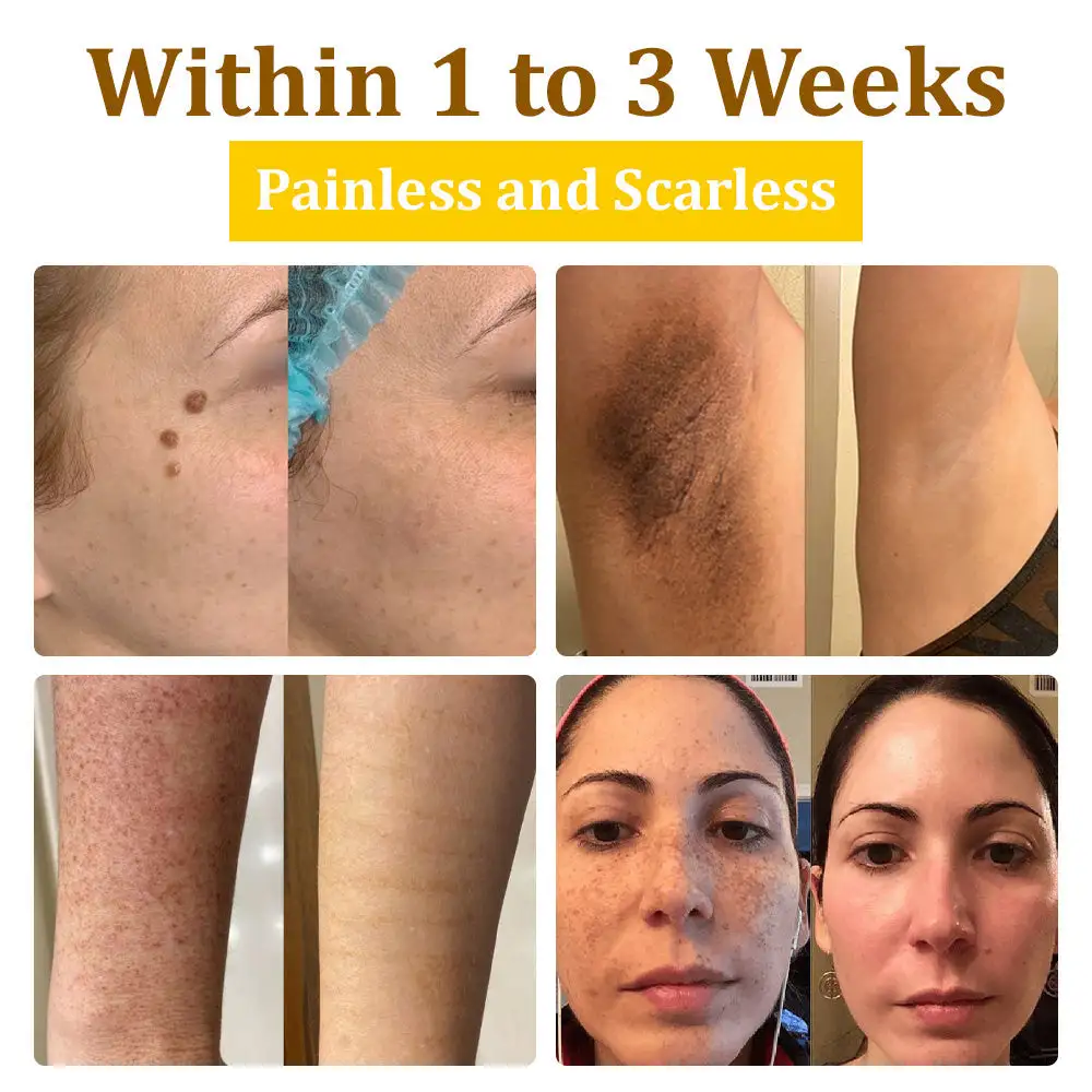 Bee Venom Treatment Cream🐝: Treat Eczema, Psoriasis, Acne, Rosacea, Fungal Infections, Warts - Image 3