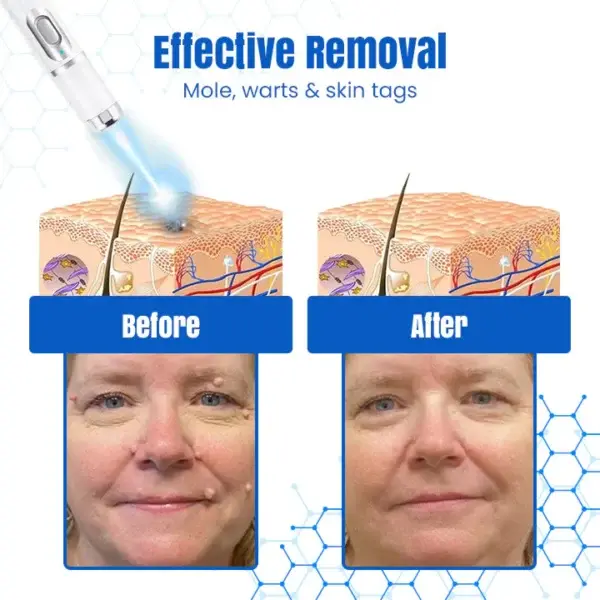 DermZap Mole & Wart Removal Laser Pen - Image 6
