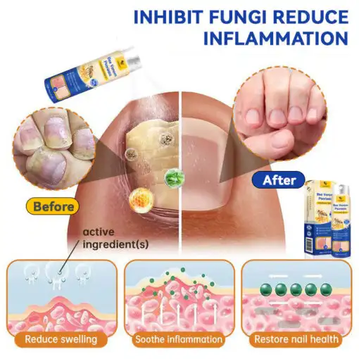 PsoriaHeal Bee Venom Psoriasis Treatment Spray plus - Image 11