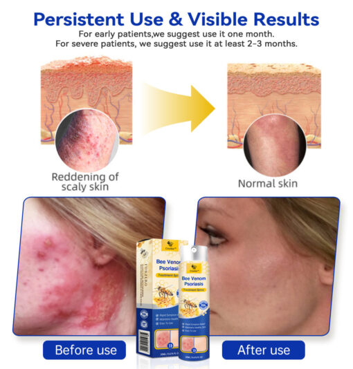 PsoriaHeal Bee Venom Psoriasis Treatment Spray plus - Image 4