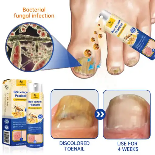 PsoriaHeal Bee Venom Psoriasis Treatment Spray plus - Image 8