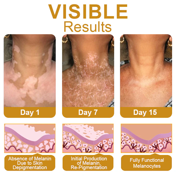 BeeVenom Vitiligo Treatment Cream - Image 4