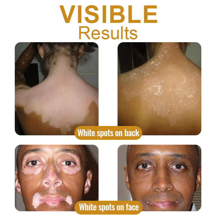 BeeVenom Vitiligo Treatment Cream - Image 5