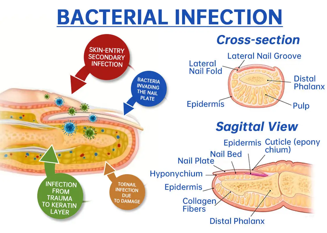 PureNail Fungus Laser Device - Image 4