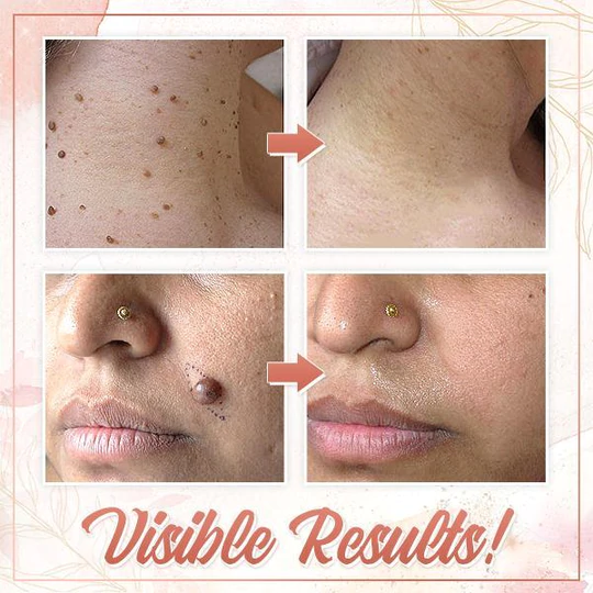 Herbal Wart Skin Removal Ointment - Image 11