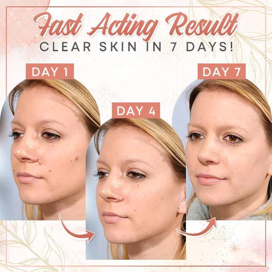 Herbal Wart Skin Removal Ointment - Image 4