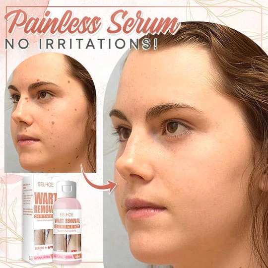 Herbal Wart Skin Removal Ointment - Image 5