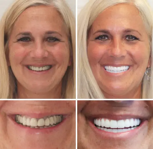 Advanced Customized Full Denture Set - Image 5