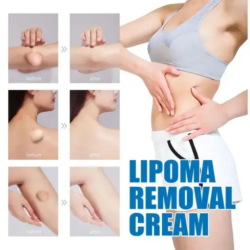 LIPOMA CREAM - Image 3