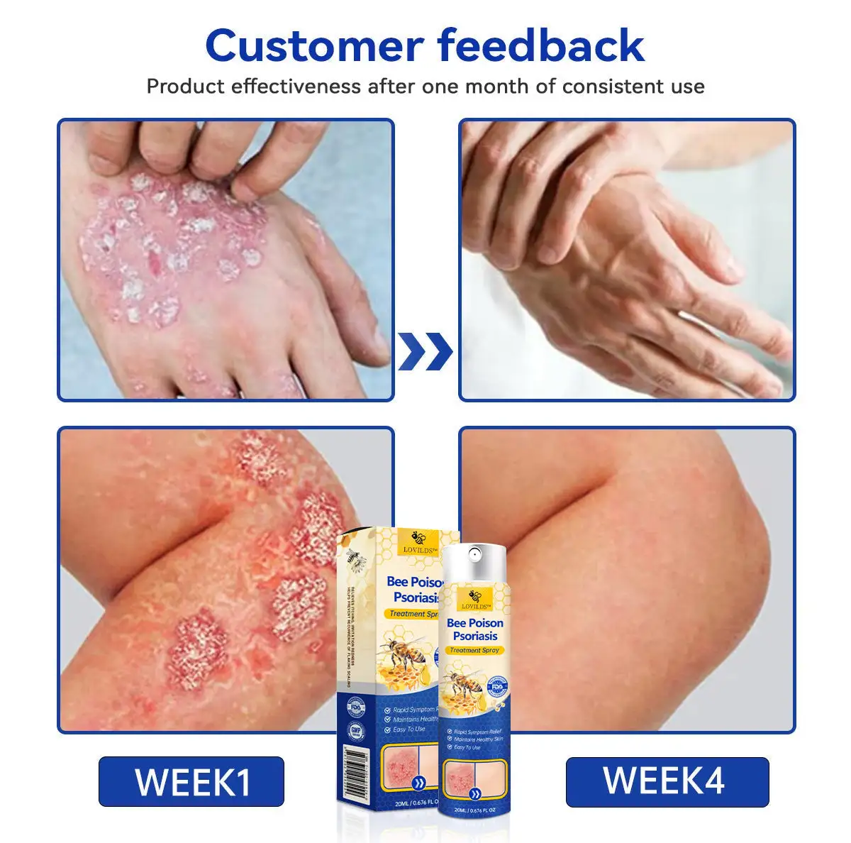 PsoriaHeal psoriasis Spray pro - Image 6