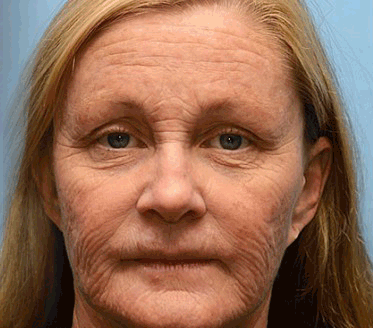 Botox & Retinol Shot - Image 2