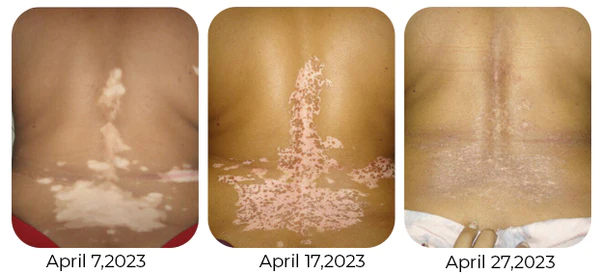 Vitiligo Therapy Cream - Image 8