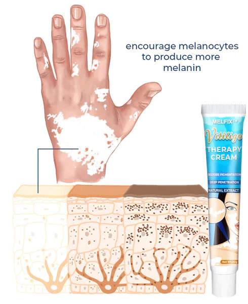 Vitiligo Therapy Cream - Image 2