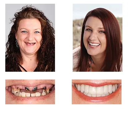Custom-Fit Functional Dentures Smile with Confidence - Image 8