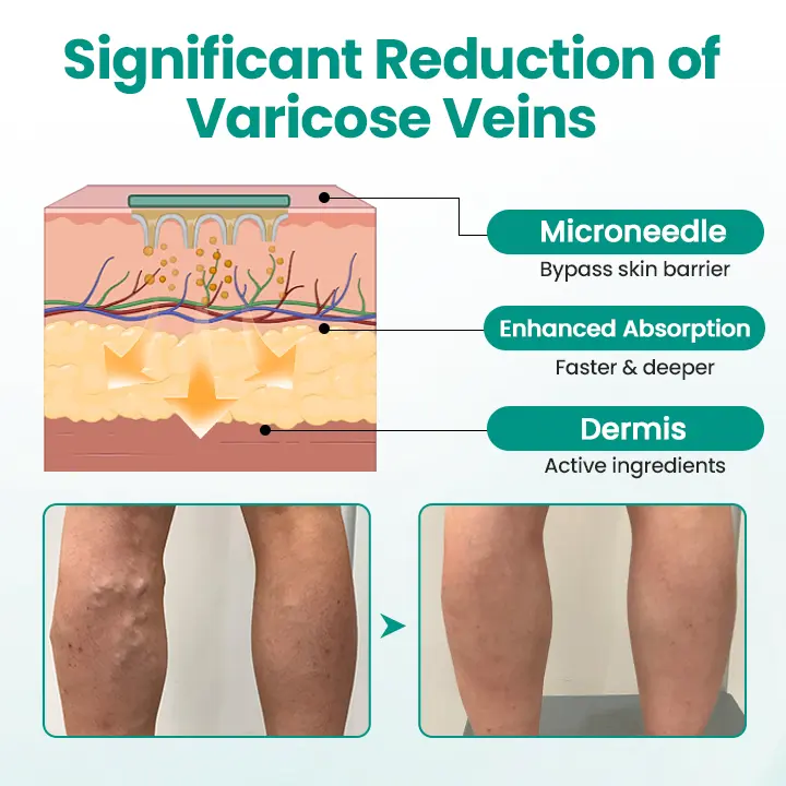 LegRenew Varicose Veins Patch - Image 2
