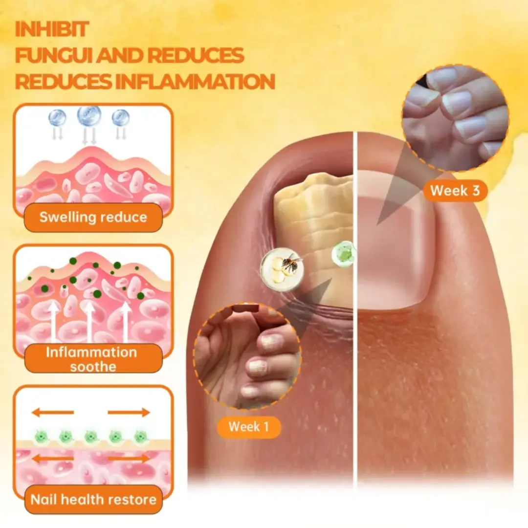 26 Pcs Left !!! - Bee Venom Nail Renewal Spray - LIMITED-TIME OFFER - Image 3