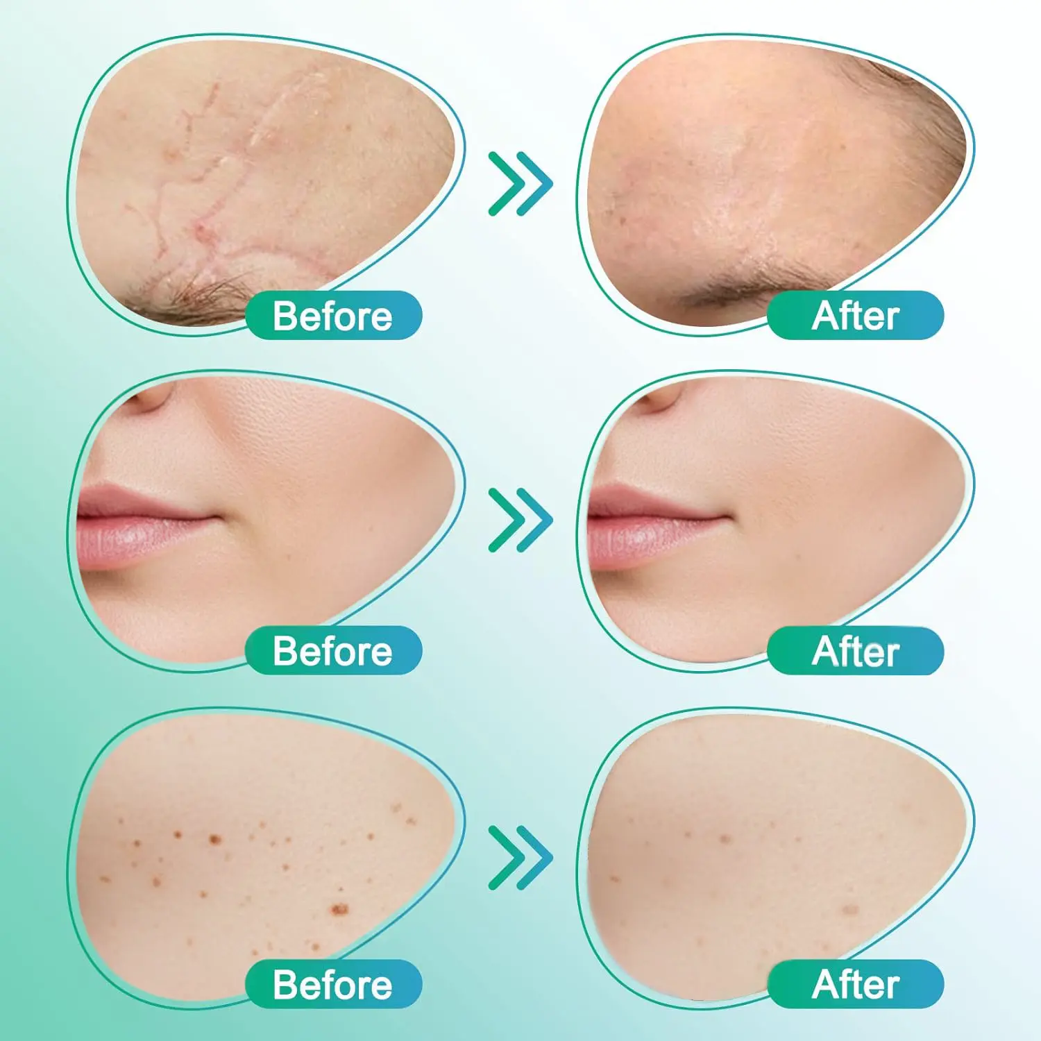 3-in-1 Microneedle Care Patch - Image 5