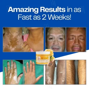 Alternative view of VitiClear Bee Venom Cream | No More Hiding that Skin!