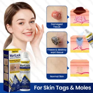 Alternative view of 🔥Best WartLock Cryo-Recovery Cooling Spray🎉Special limited-time discount