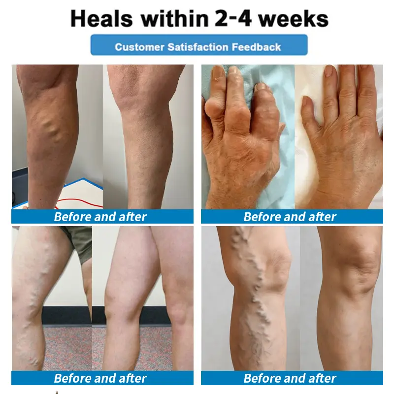 🛒4-in-1 Vein & Joint Nano Microneedle Advanced Therapy Patch🔥 - Image 6