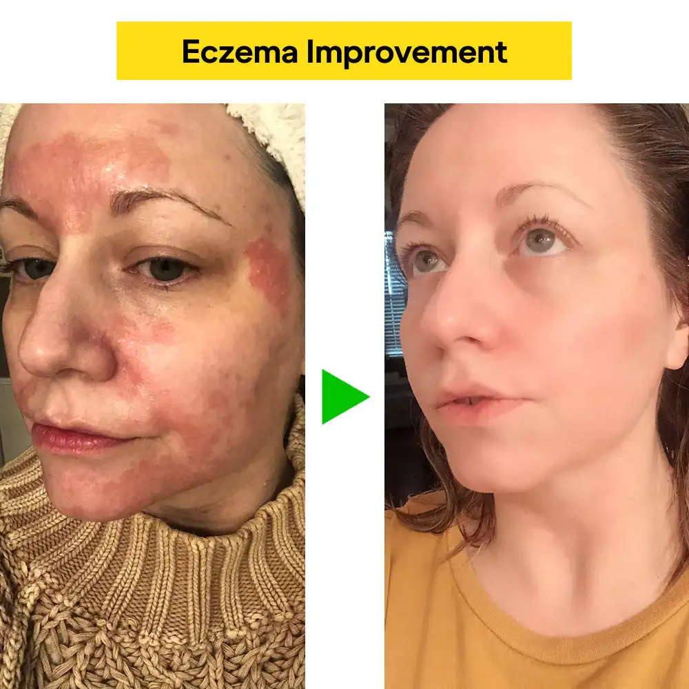 Eczema & Psoriasis Natural Herbal Cream - Image 2