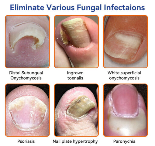 Bee Venom Nail Fungus Treatment Solution - Image 3