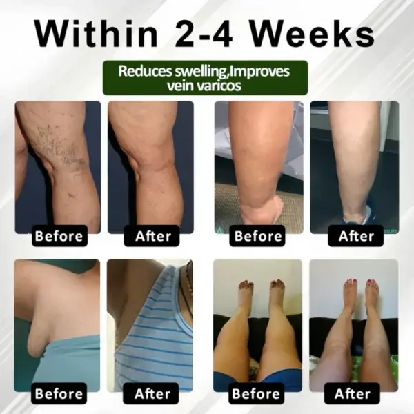 Leg Therapy Edema Cream - Image 2