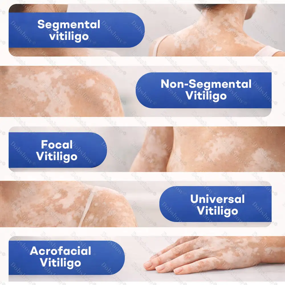 Piperine Vitiligo Repigmentation Spray - Image 2