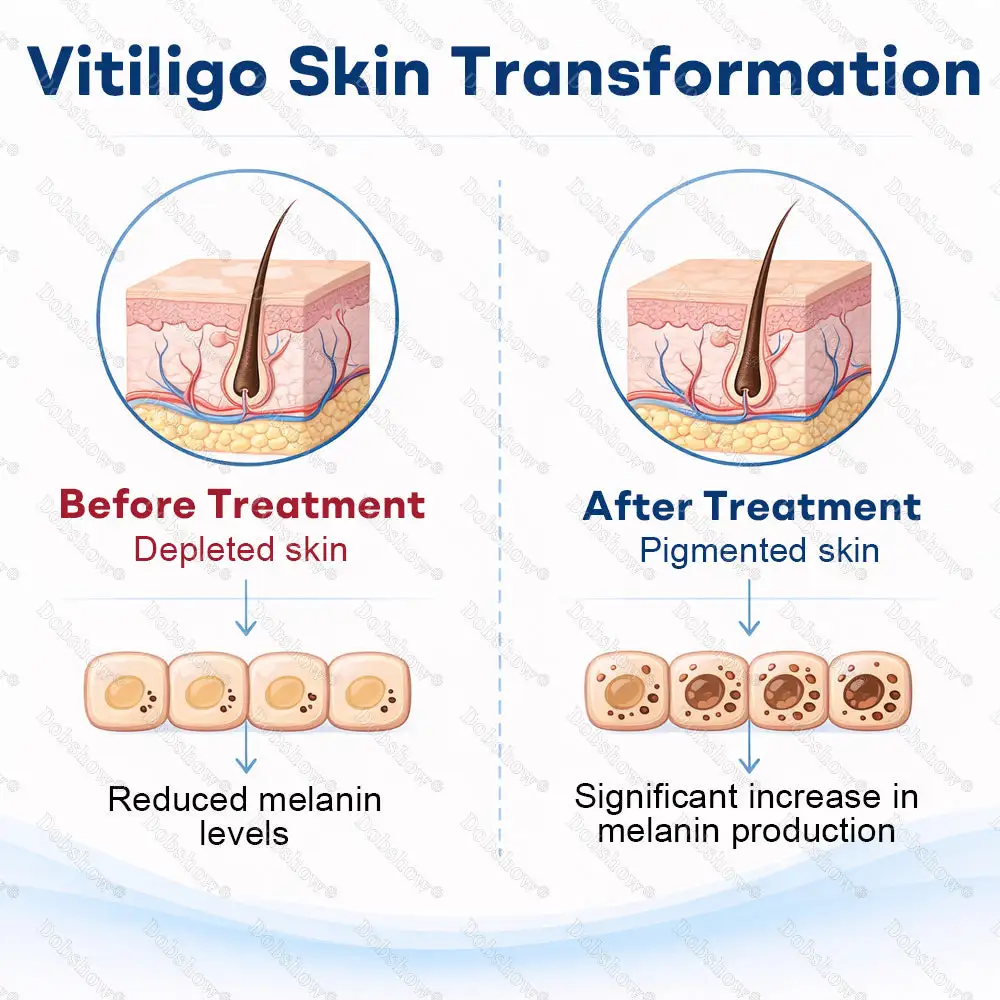 Piperine Vitiligo Repigmentation Spray - Image 4