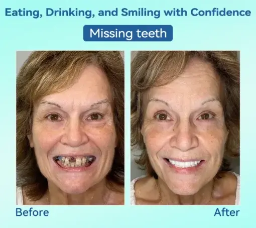 Premium Denture AdaptableFit Functional Dentures - Image 11