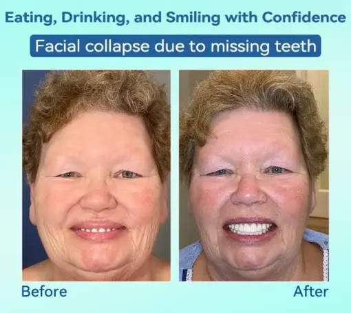 Premium Denture AdaptableFit Functional Dentures - Image 12