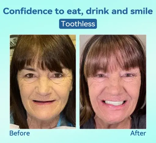 Premium Denture AdaptableFit Functional Dentures - Image 6