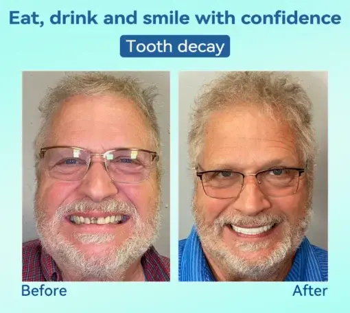 Premium Denture AdaptableFit Functional Dentures - Image 9