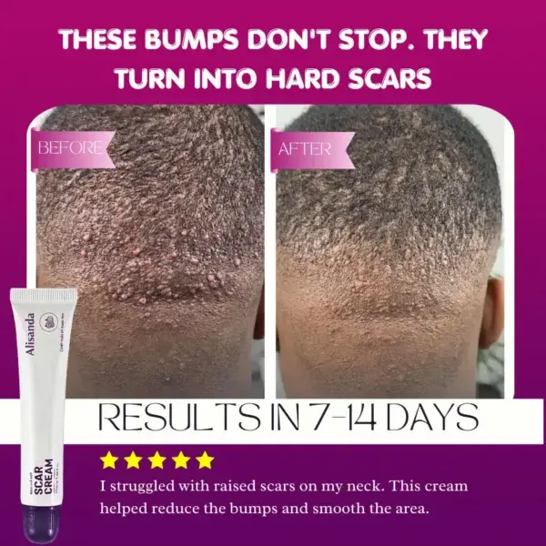 Keloid & Raised Scar Removal Cream - Image 2