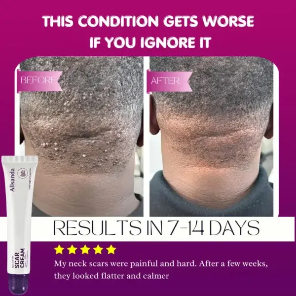 Keloid & Raised Scar Removal Cream - Image 3