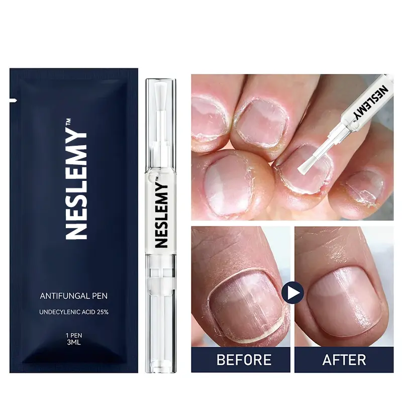 Antifungal Pen – 25% Undecylenic Acid Treatment for Athlete’s Foot &Skin Fungus - Image 3