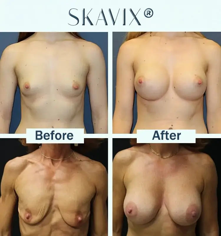 Skavix Targeted Breast Enhancement Advanced Nano-Microneedle Patches - Image 5