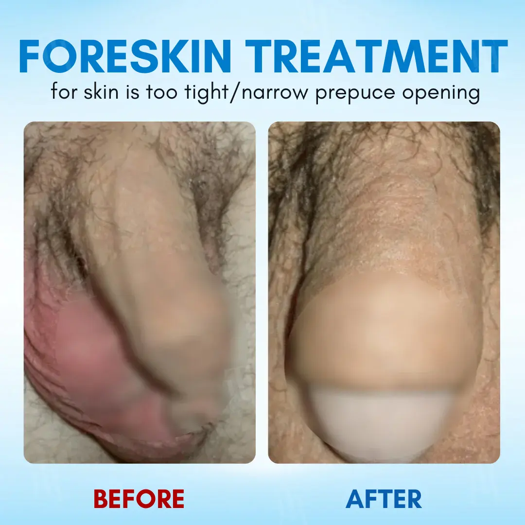 Foreskin Elasticity Gel - Image 2