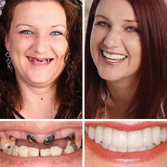 Custom-Fit Dentures— Designed for Comfort and a Natural-Looking Smile - Image 10