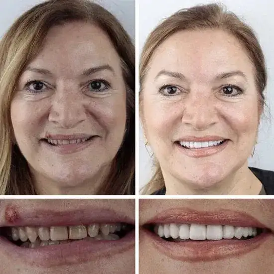 Custom-Fit Dentures— Designed for Comfort and a Natural-Looking Smile - Image 11