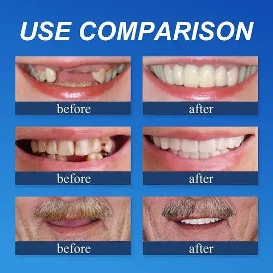 Custom-Fit Dentures— Designed for Comfort and a Natural-Looking Smile - Image 4