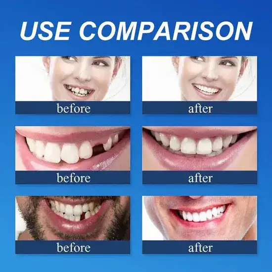 Custom-Fit Dentures— Designed for Comfort and a Natural-Looking Smile - Image 6